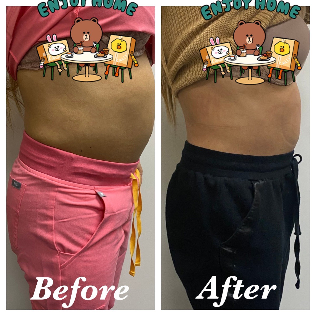 Body Contouring Gallery Smooth Image Electrolysis